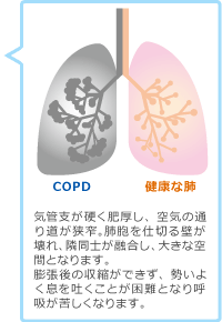 copd説明